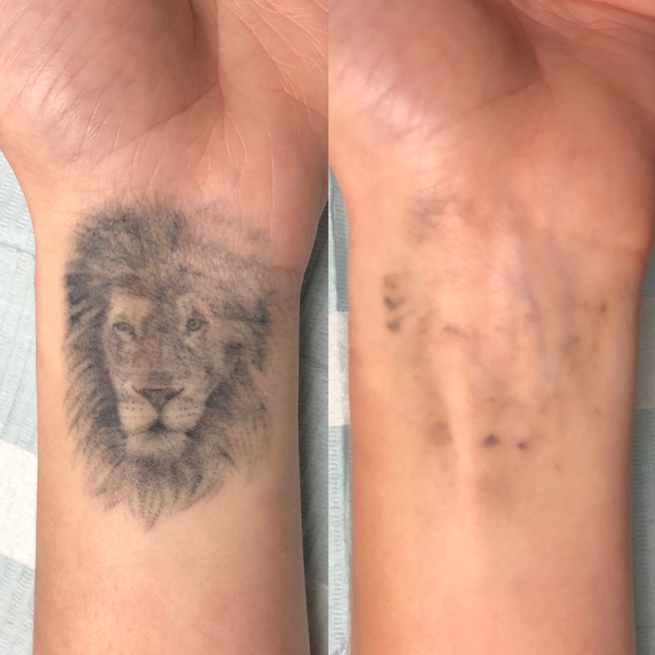 Laser Tattoo Removal Vancouver / Toronto Adrenaline Studios