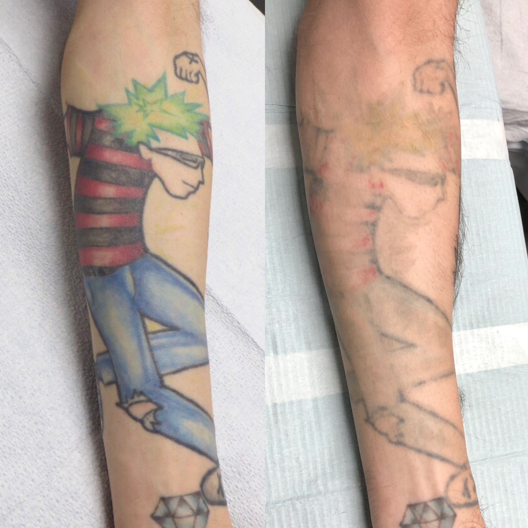 craig gilbert laser tattoo removal vancouver adrenaline