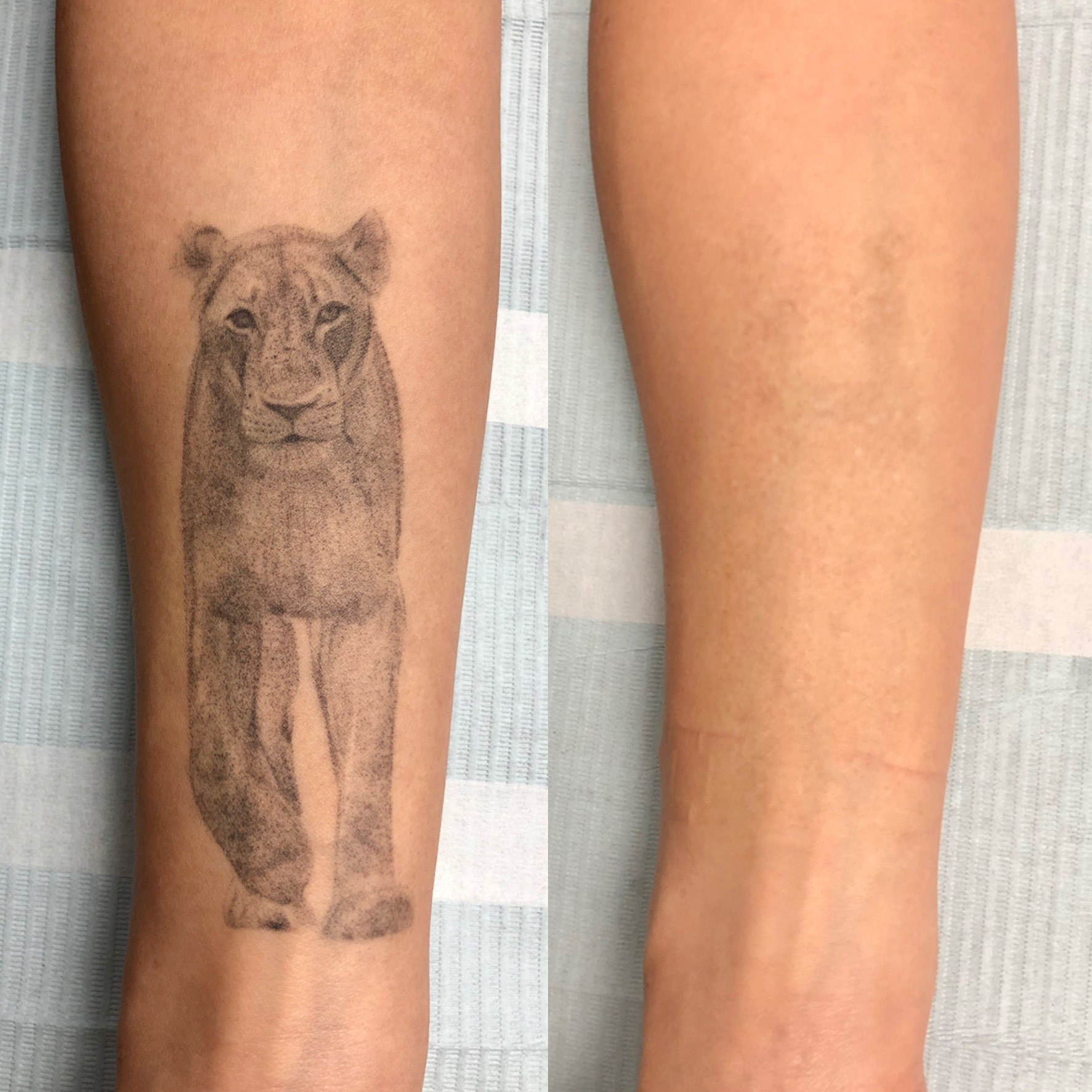 Does Laser Tattoo Removal leave Scars or Blisters Orange Coast  Aesthetics Cosmetic Specialists