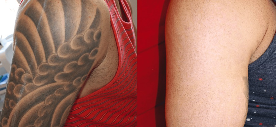Benefits of Laser Tattoo Removal