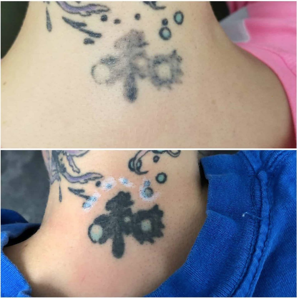 Laser Tattoo Removal Specialist Vancouver BC Jenny Ertl