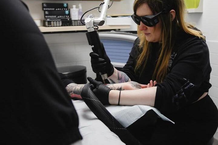 Tattoo Removal Kitsilano